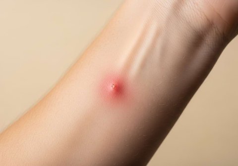 A close-up of a small patch of red, inflamed skin from a cactus needle irritation.
